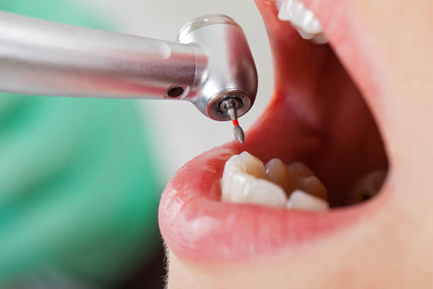 Best Emergency Root Canal Treatment in Hamilton College, NY